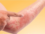XÉT NGHIỆM NGỨA DỊ ỨNG